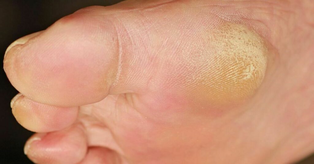 Callus formation on sole - callus under the foot