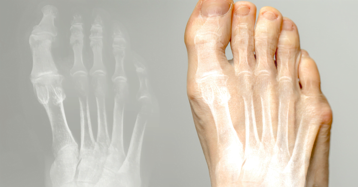 Hallux valgus treatment – toe spreader and footwear