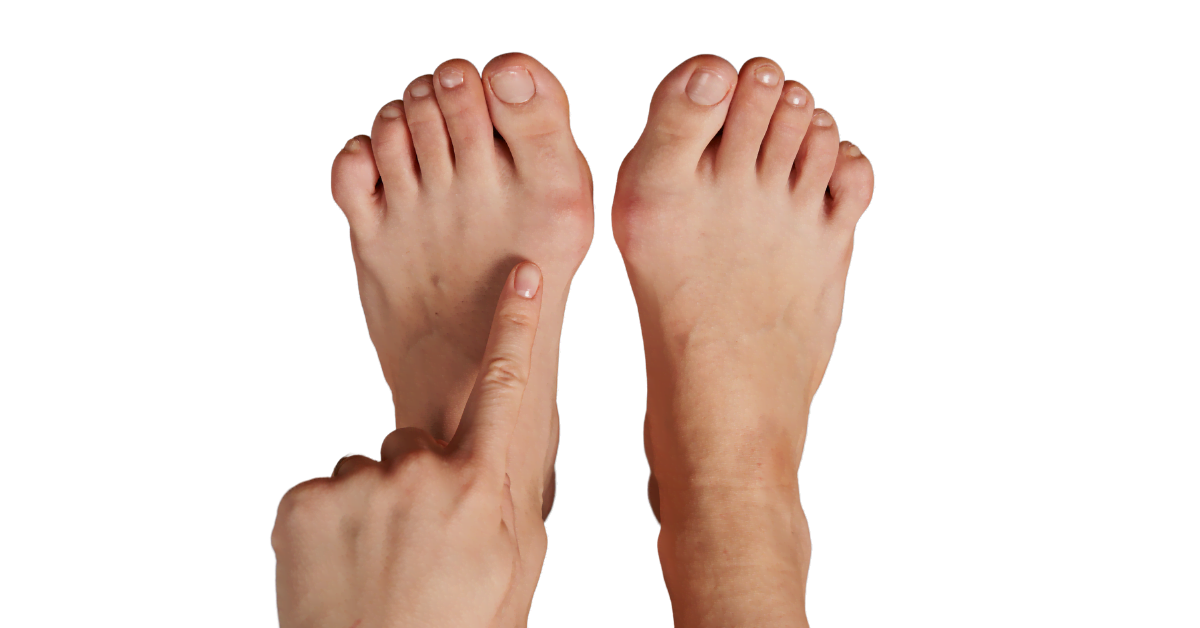 Hallux valgus - misalignment of the big toe