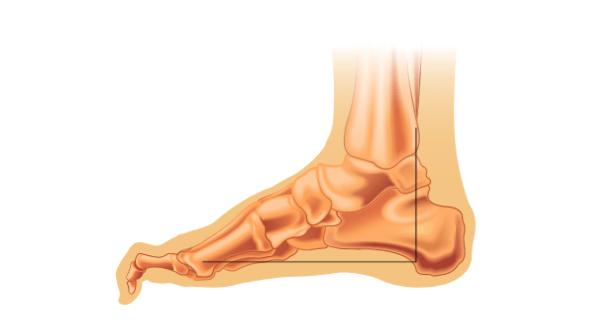 Hammertoes: Painful but Treatable