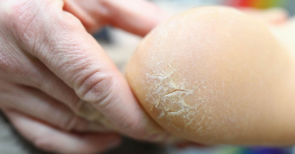 Heel cracks – splits and fissures in the skin of the heel