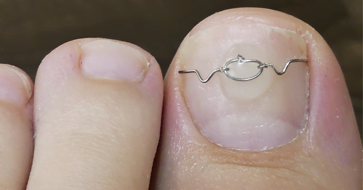 Ingrown Toenail – Treatment and Prevention