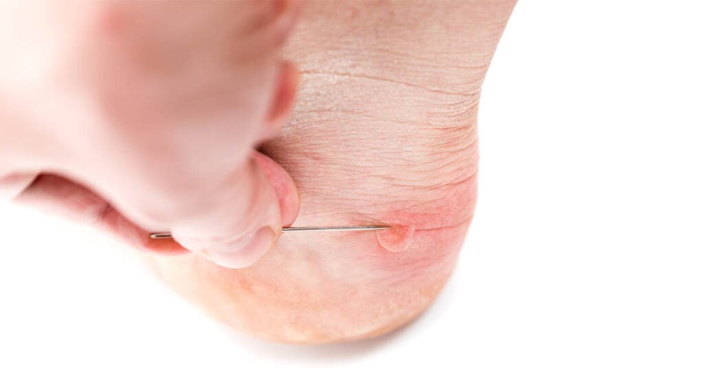 Puncturing a foot blister – working sterile with needle or blister lance
