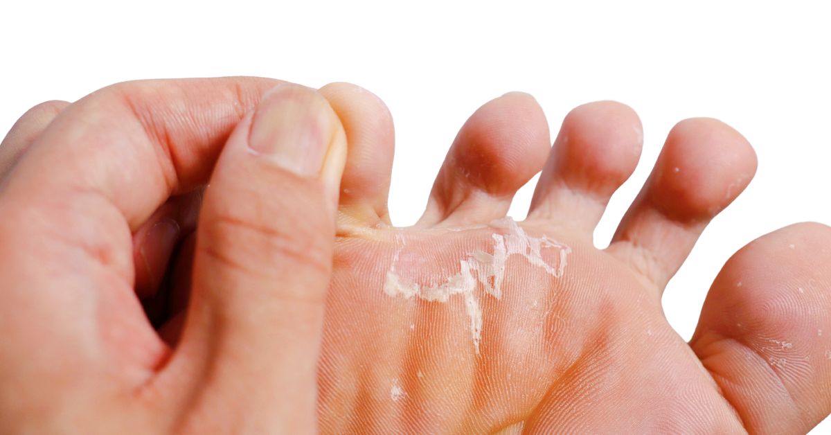 Fungal infection between the toes