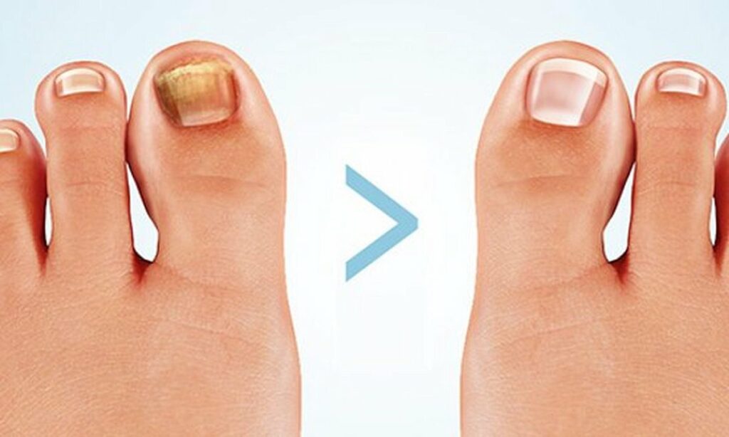 Treating bald nails