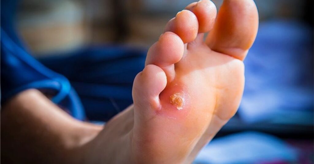 Corn on ball of foot