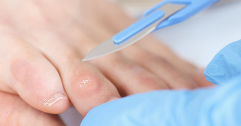 Corn removal by pedicurist