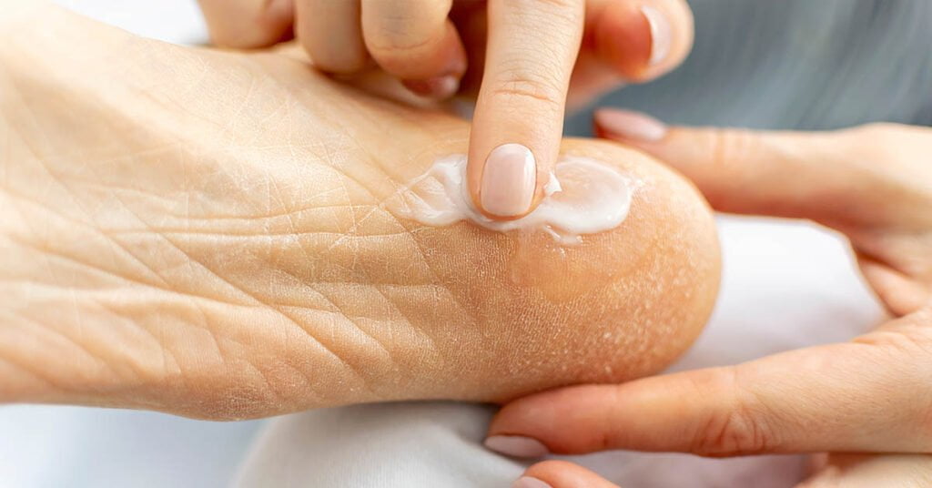 Lubricating heels with cream