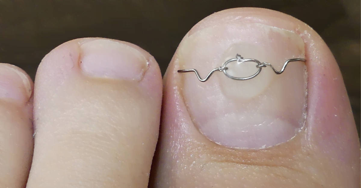 ingrown nail with nail brace